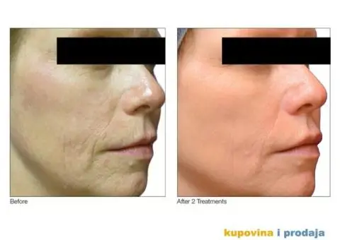 VENUS VIVA radiofrekvencija za napredne anti age tretmane lica i tijela - 2/4