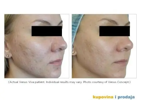 VENUS VIVA radiofrekvencija za napredne anti age tretmane lica i tijela - 3/4