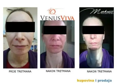 VENUS VIVA radiofrekvencija za napredne anti age tretmane lica i tijela - 4/4