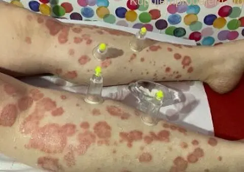 Hidzamom do balansa, Jaca - 1/3