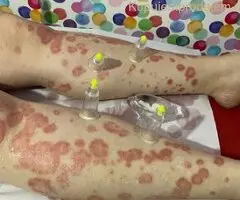 Hidzamom do balansa, Jaca