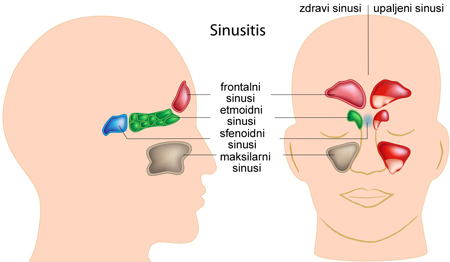 Sinusi, upala sinusa, lečenje sinusa, zapušen nos